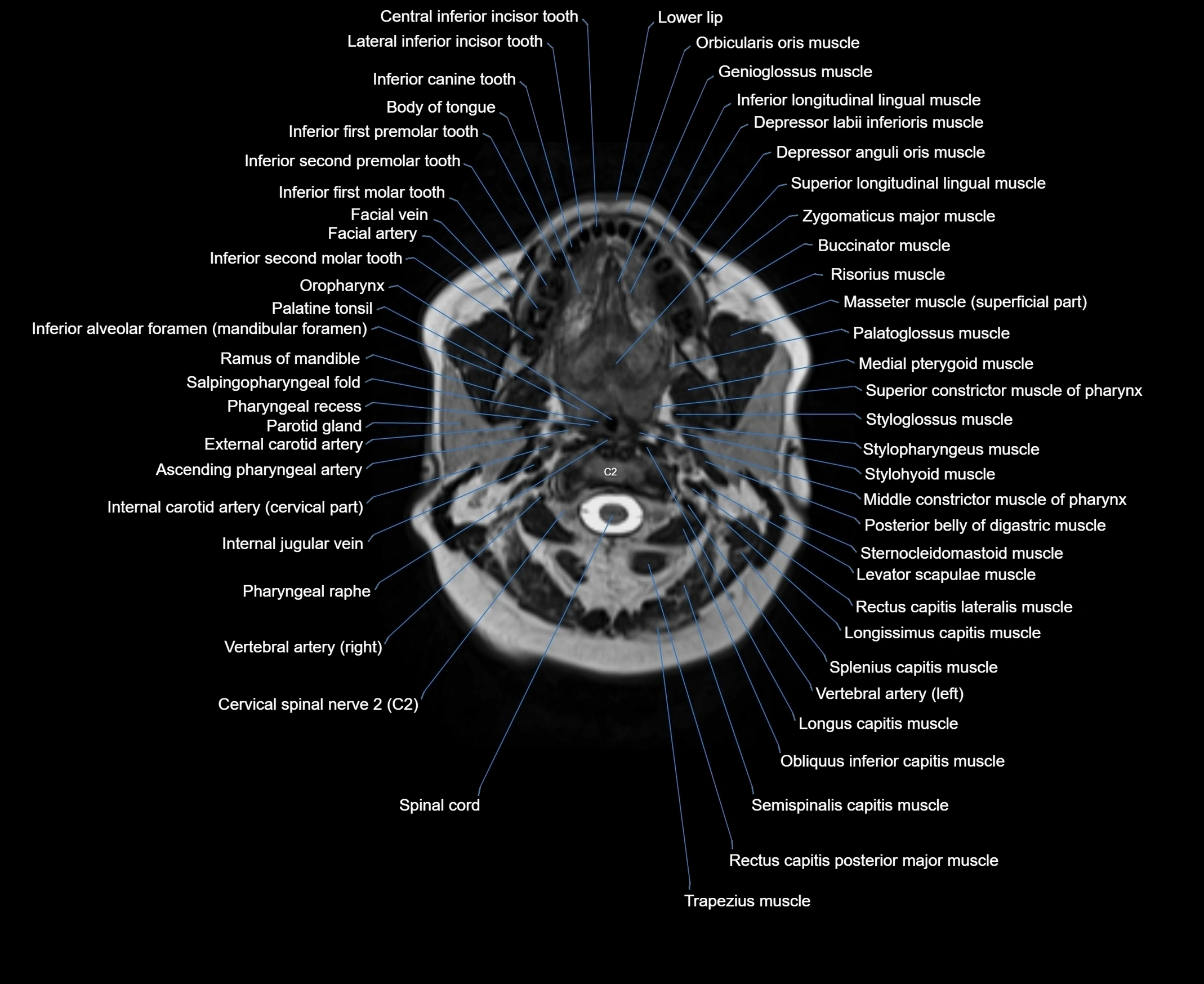 MRI Neck 3D labelled cross section anatomy axial 3t image-00001-00031.webp